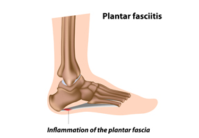 Inflammation of Plantar Fascia and Treatment